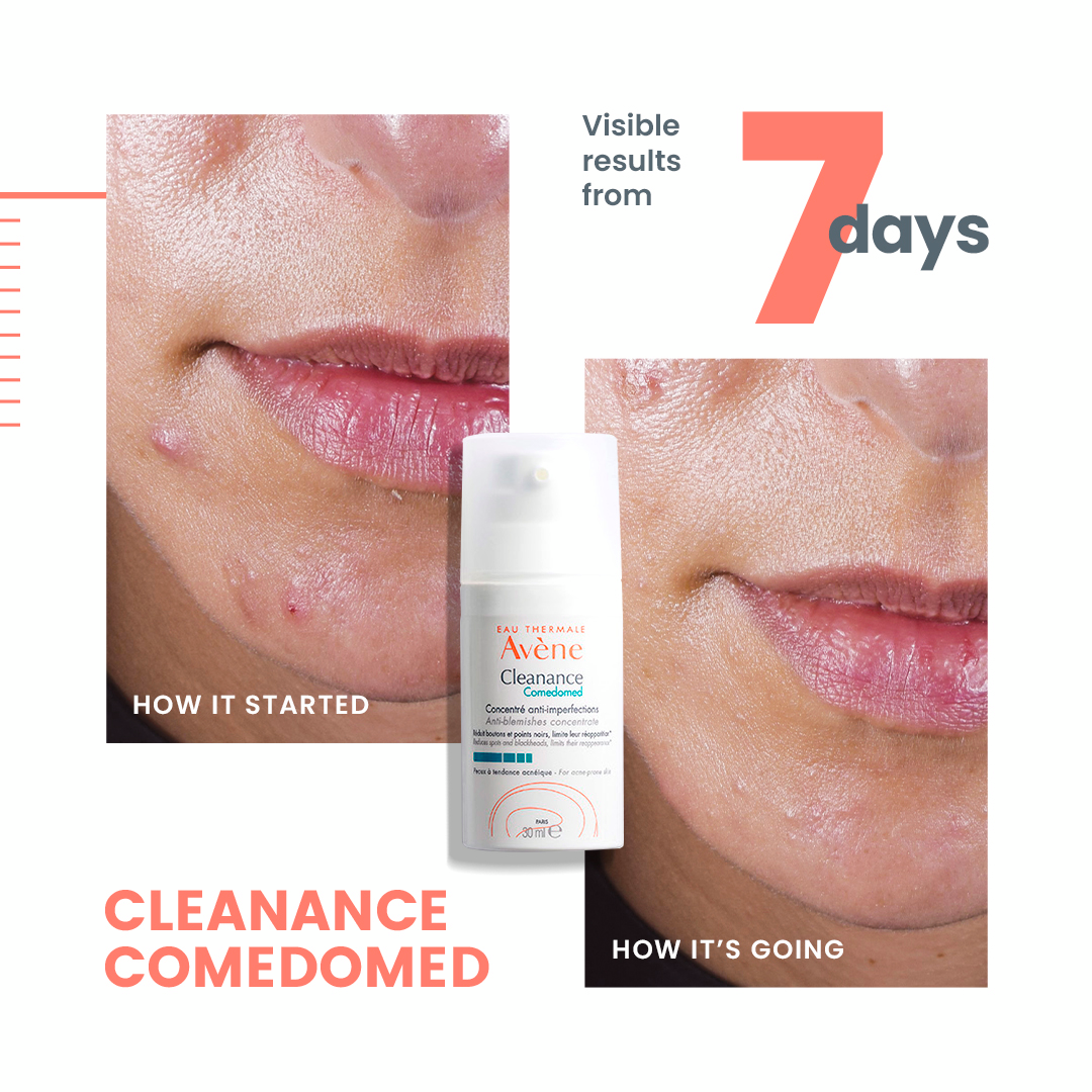 Avène Cleanance Comedomed Anti-Blemish Concentrate Results